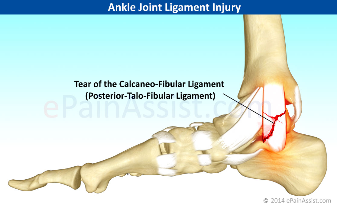 Sprain of calcaneofibular ligament of left ankle